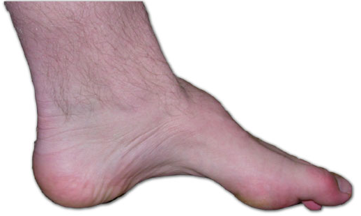 Foot-drop-example